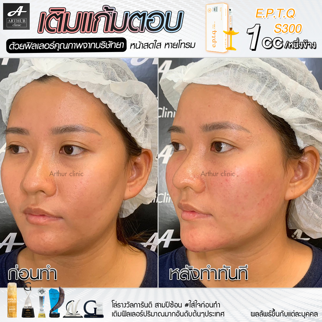 filler-แก้มตอบ-12